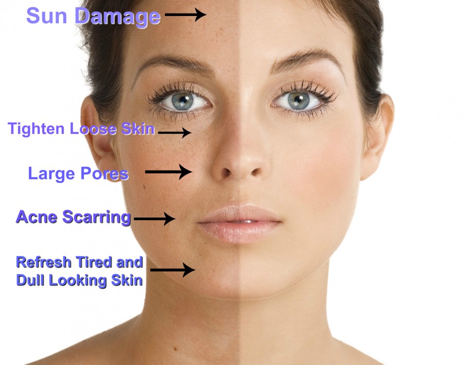 What Is A Chemical Peel Treatment