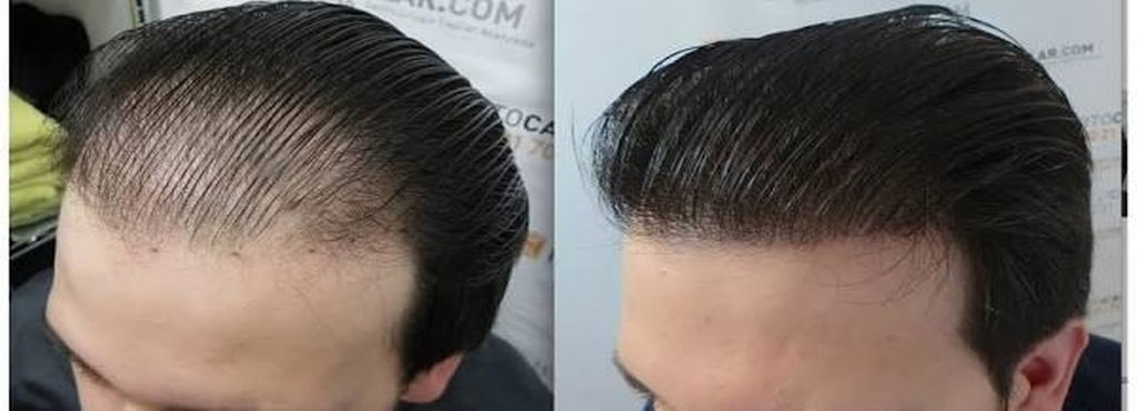 hair-transplantation